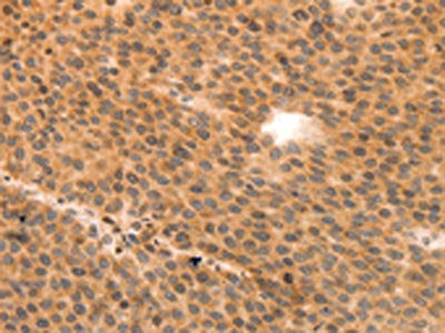 The image on the left is immunohistochemistry of paraffin-embedded Human liver cancer tissue using the antibody Antibody) at dilution 1/80, on the right is treated with synthetic peptide. (Original magnification: ×200)Rabbit anti-Human MYL9 Polyclonal Antibody