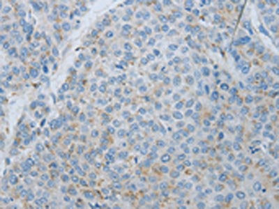 The image on the left is immunohistochemistry of paraffin-embedded Human liver cancer tissue using MMP25 Antibody(MMP25 Antibody) at dilution 1/80, on the right is treated with synthetic peptide. (Original magnification: ×200)Rabbit anti-Human MMP25 Polyclonal Antibody