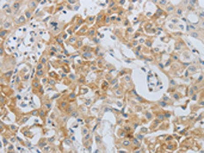 The image on the left is immunohistochemistry of paraffin-embedded Human lung cancer tissue using the antibody Antibody) at dilution 1/80, on the right is treated with synthetic peptide. (Original magnification: ×200)Rabbit anti-Human MMP25 Polyclonal Antibody