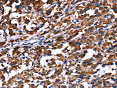 The image on the left is immunohistochemistry of paraffin-embedded Human thyroid cancer tissue using PHB Antibody(PHB Antibody) at dilution 1/30, on the right is treated with fusion protein. (Original magnification: ×200)Rabbit anti-Human PHB Polyclonal Antibody