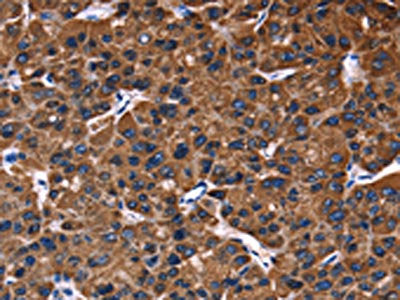 The image on the left is immunohistochemistry of paraffin-embedded Human liver cancer tissue using the antibody Antibody) at dilution 1/30, on the right is treated with fusion protein. (Original magnification: ×200)Rabbit anti-Human PHB Polyclonal Antibody