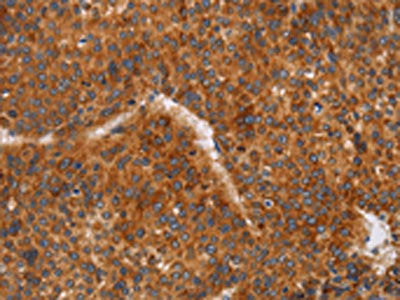 The image on the left is immunohistochemistry of paraffin-embedded Human liver cancer tissue using the antibody Antibody) at dilution 1/60, on the right is treated with synthetic peptide. (Original magnification: ×200)Rabbit anti-Human CD38 Polyclonal Antibody