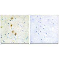 Immunohistochemistry analysis of paraffin-embedded human breast carcinoma tissue using Akt (Ab-326) antibody.Rabbit anti-Human AKT1 Polyclonal Antibody