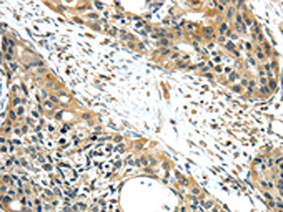 The image on the left is immunohistochemistry of paraffin-embedded Human esophagus cancer tissue using ISM2 Antibody(ISM2 Antibody) at dilution 1/40, on the right is treated with synthetic peptide. (Original magnification: ×200)