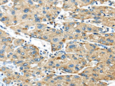 The image on the left is immunohistochemistry of paraffin-embedded Human liver cancer tissue using the antibody Antibody) at dilution 1/40, on the right is treated with synthetic peptide. (Original magnification: ×200)