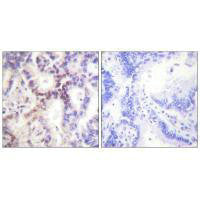 Immunohistochemical analysis of paraffin-embedded human lung carcinoma tissue using p15 INK antibody.Rabbit anti-Human CDKN2B Polyclonal Antibody