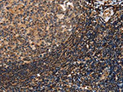 The image on the left is immunohistochemistry of paraffin-embedded Human tonsil tissue using the antibody Antibody) at dilution 1/40, on the right is treated with synthetic peptide. (Original magnification: ×200)Rabbit anti-Human PON1 Polyclonal Antibody