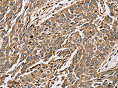The image on the left is immunohistochemistry of paraffin-embedded Human lung cancer tissue using PTGER2 Antibody(PTGER2 Antibody) at dilution 1/45, on the right is treated with synthetic peptide. (Original magnification: ×200)Rabbit anti-Human PTGER2 Polyclonal Antibody