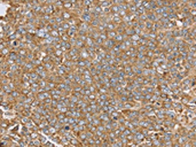 The image on the left is immunohistochemistry of paraffin-embedded Human ovarian cancer tissue using the antibody Antibody) at dilution 1/45, on the right is treated with synthetic peptide. (Original magnification: ×200)Rabbit anti-Human PTGER2 Polyclonal Antibody