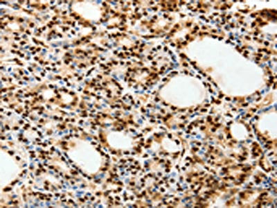 The image on the left is immunohistochemistry of paraffin-embedded Human thyroid cancer tissue using SPATA20 Antibody(SPATA20 Antibody) at dilution 1/70, on the right is treated with synthetic peptide. (Original magnification: ×200)Rabbit anti-Human SPATA20 Polyclonal Antibody