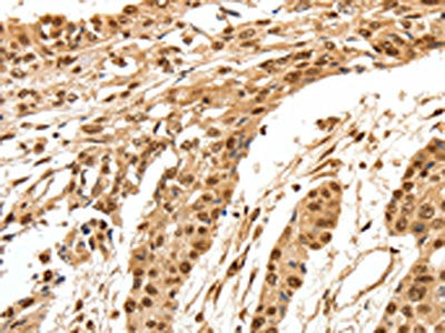 The image on the left is immunohistochemistry of paraffin-embedded Human esophagus cancer tissue using the antibody Antibody) at dilution 1/70, on the right is treated with synthetic peptide. (Original magnification: ×200)Rabbit anti-Human SPATA20 Polyclonal Antibody