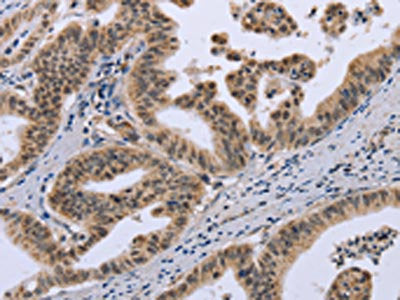 The image on the left is immunohistochemistry of paraffin-embedded Human gastric cancer tissue using FOXO1 Antibody(FOXO1  Antibody) at dilution 1/30, on the right is treated with synthetic peptide. (Original magnification: ×200)Rabbit anti-Human FOXO1 Polyclonal Antibody