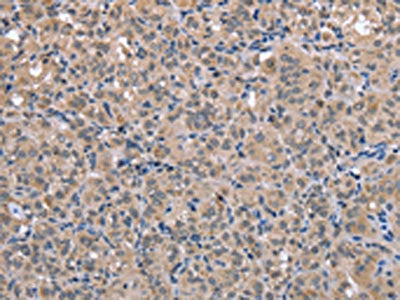The image on the left is immunohistochemistry of paraffin-embedded Human thyroid cancer tissue using the antibody  Antibody) at dilution 1/30, on the right is treated with synthetic peptide. (Original magnification: ×200)Rabbit anti-Human FOXO1 Polyclonal Antibody