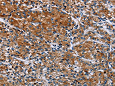 The image on the left is immunohistochemistry of paraffin-embedded Human prostate cancer tissue using HYAL3 Antibody(HYAL3 Antibody) at dilution 1/40, on the right is treated with fusion protein. (Original magnification: ×200)Rabbit anti-Human HYAL3 Polyclonal Antibody