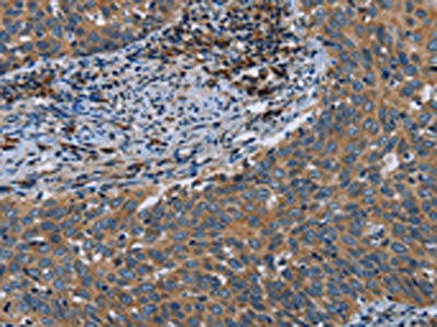 The image on the left is immunohistochemistry of paraffin-embedded Human cervical cancer tissue using the antibody Antibody) at dilution 1/40, on the right is treated with fusion protein. (Original magnification: ×200)Rabbit anti-Human HYAL3 Polyclonal Antibody