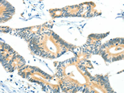 The image on the left is immunohistochemistry of paraffin-embedded Human colon cancer tissue using BCAT1 Antibody(BCAT1 Antibody) at dilution 1/50, on the right is treated with fusion protein. (Original magnification: ×200)Rabbit anti-Human BCAT1 Polyclonal Antibody