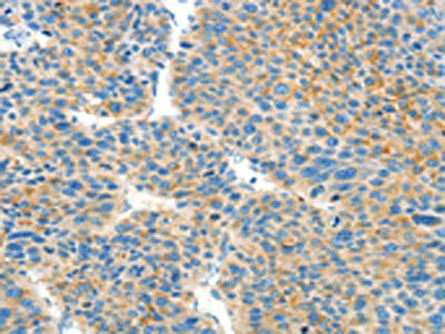 The image on the left is immunohistochemistry of paraffin-embedded Human liver cancer tissue using the antibody Antibody) at dilution 1/50, on the right is treated with fusion protein. (Original magnification: ×200)