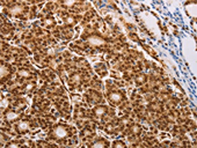 The image on the left is immunohistochemistry of paraffin-embedded Human thyroid cancer tissue using PSMD3 Antibody(PSMD3 Antibody) at dilution 1/25, on the right is treated with fusion protein. (Original magnification: ×200)Rabbit anti-Human PSMD3 Polyclonal Antibody
