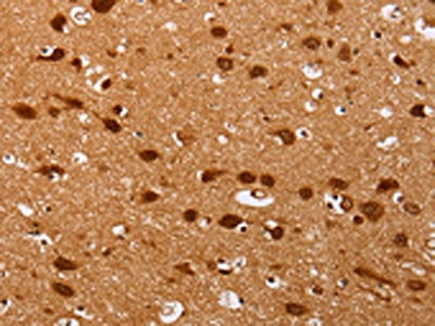 The image on the left is immunohistochemistry of paraffin-embedded Human brain tissue using the antibody Antibody) at dilution 1/25, on the right is treated with fusion protein. (Original magnification: ×200)Rabbit anti-Human PSMD3 Polyclonal Antibody