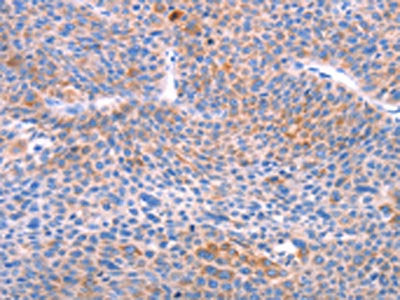 The image on the left is immunohistochemistry of paraffin-embedded Human liver cancer tissue using AADAC Antibody(AADAC Antibody) at dilution 1/30, on the right is treated with fusion protein. (Original magnification: ×200)