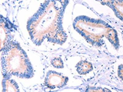 The image on the left is immunohistochemistry of paraffin-embedded Human colon cancer tissue using the antibody Antibody) at dilution 1/30, on the right is treated with fusion protein. (Original magnification: ×200)