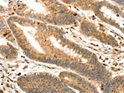 The image on the left is immunohistochemistry of paraffin-embedded Human colon cancer tissue using the antibody Antibody) at dilution 1/30, on the right is treated with synthetic peptide. (Original magnification: ×200)Rabbit anti-Human S100A4 Polyclonal Antibody