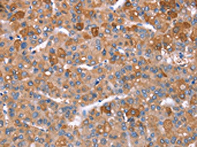 The image on the left is immunohistochemistry of paraffin-embedded Human liver cancer tissue using the antibody Antibody) at dilution 1/40, on the right is treated with synthetic peptide. (Original magnification: ×200)Rabbit anti-Human GPC6 Polyclonal Antibody