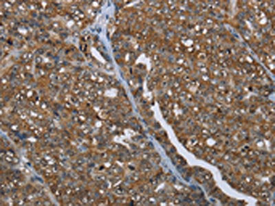 The image on the left is immunohistochemistry of paraffin-embedded Human ovarian cancer tissue using PRDM2 Antibody(PRDM2 Antibody) at dilution 1/25, on the right is treated with synthetic peptide. (Original magnification: ×200)Rabbit anti-Human PRDM2 Polyclonal Antibody
