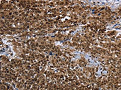 The image on the left is immunohistochemistry of paraffin-embedded Human cervical cancer tissue using the antibody Antibody) at dilution 1/25, on the right is treated with synthetic peptide. (Original magnification: ×200)Rabbit anti-Human PRDM2 Polyclonal Antibody