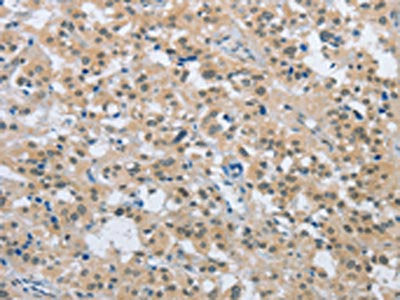 The image on the left is immunohistochemistry of paraffin-embedded Human thyroid cancer tissue using ENTPD5 Antibody(ENTPD5 Antibody) at dilution 1/20, on the right is treated with fusion protein. (Original magnification: ×200)Rabbit anti-Human ENTPD5 Polyclonal Antibody