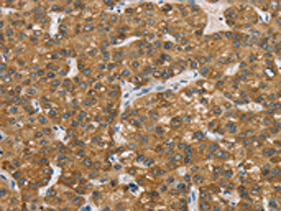 The image on the left is immunohistochemistry of paraffin-embedded Human liver cancer tissue using the antibody Antibody) at dilution 1/20, on the right is treated with fusion protein. (Original magnification: ×200)Rabbit anti-Human ENTPD5 Polyclonal Antibody