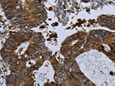 The image on the left is immunohistochemistry of paraffin-embedded Human colon cancer tissue using GLUL Antibody(GLUL Antibody) at dilution 1/60, on the right is treated with fusion protein. (Original magnification: ×200)Rabbit anti-Human GLUL Polyclonal Antibody