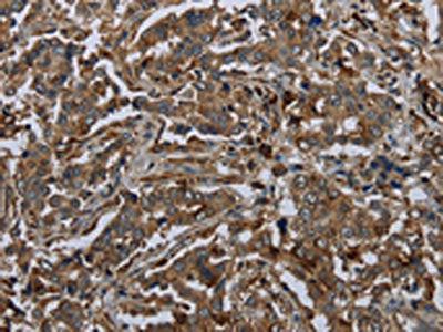 The image on the left is immunohistochemistry of paraffin-embedded Human liver cancer tissue using the antibody Antibody) at dilution 1/60, on the right is treated with fusion protein. (Original magnification: ×200)Rabbit anti-Human GLUL Polyclonal Antibody