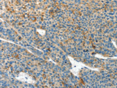 The image on the left is immunohistochemistry of paraffin-embedded Human liver cancer tissue using CLPTM1L Antibody(CLPTM1L Antibody) at dilution 1/60, on the right is treated with synthetic peptide. (Original magnification: ×200)Rabbit anti-Human CLPTM1L Polyclonal Antibody