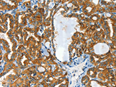 The image on the left is immunohistochemistry of paraffin-embedded Human thyroid cancer tissue using the antibody Antibody) at dilution 1/60, on the right is treated with synthetic peptide. (Original magnification: ×200)Rabbit anti-Human CLPTM1L Polyclonal Antibody