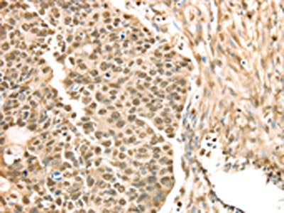 The image on the left is immunohistochemistry of paraffin-embedded Human esophagus cancer tissue using SAMD3 Antibody(SAMD3 Antibody) at dilution 1/25, on the right is treated with fusion protein. (Original magnification: ×200)Rabbit anti-Human SAMD3 Polyclonal Antibody