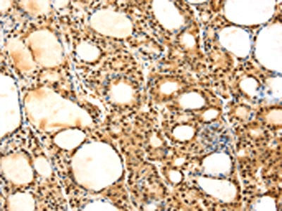 The image on the left is immunohistochemistry of paraffin-embedded Human thyroid cancer tissue using the antibody Antibody) at dilution 1/25, on the right is treated with fusion protein. (Original magnification: ×200)Rabbit anti-Human SAMD3 Polyclonal Antibody