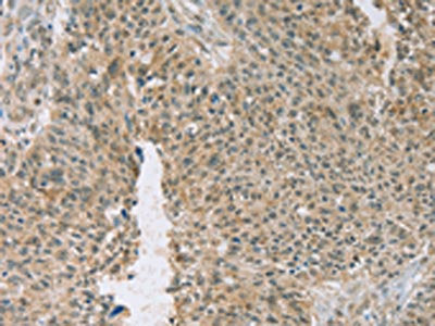 The image on the left is immunohistochemistry of paraffin-embedded Human ovarian cancer tissue using EDIL3 Antibody(EDIL3 Antibody) at dilution 1/20, on the right is treated with fusion protein. (Original magnification: ×200)Rabbit anti-Human EDIL3 Polyclonal Antibody