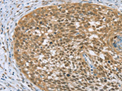 The image on the left is immunohistochemistry of paraffin-embedded Human cervical cancer tissue using the antibody Antibody) at dilution 1/20, on the right is treated with fusion protein. (Original magnification: ×200)Rabbit anti-Human EDIL3 Polyclonal Antibody