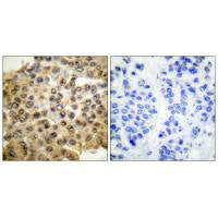 Immunohistochemical analysis of paraffin-embedded human breast carcinoma tissue, using ERK1/2 antibody.