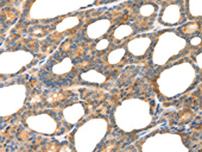 The image on the left is immunohistochemistry of paraffin-embedded Human thyroid cancer tissue using the antibody Antibody) at dilution 1/80, on the right is treated with fusion protein. (Original magnification: ×200)Rabbit anti-Human POU2F2 Polyclonal Antibody