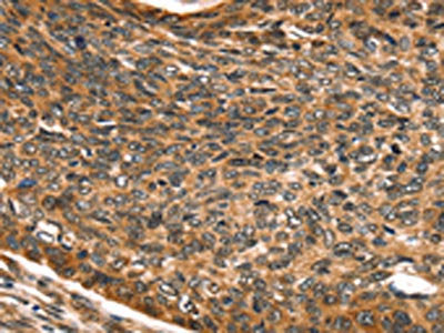The image on the left is immunohistochemistry of paraffin-embedded Human esophagus cancer tissue using SKIL Antibody(SKIL Antibody) at dilution 1/30, on the right is treated with fusion protein. (Original magnification: ×200)Rabbit anti-Human SKIL Polyclonal Antibody