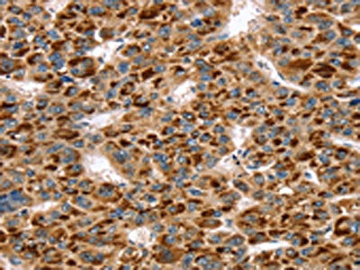 The image on the left is immunohistochemistry of paraffin-embedded Human liver cancer tissue using the antibody Antibody) at dilution 1/30, on the right is treated with fusion protein. (Original magnification: ×200)Rabbit anti-Human SKIL Polyclonal Antibody