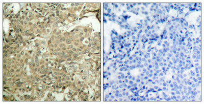 Immunohistochemical analysis of paraffin-embedded human breast carcinoma tissue using cofilin(Phospho-Ser3) Antibody(left) or the same antibody preincubated with blocking peptide(right).Rabbit anti-Human CFL1 Polyclonal Antibody