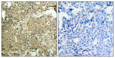 Immunohistochemical analysis of paraffin-embedded human breast carcinoma tissue using cofilin(Phospho-Ser3) Antibody(left) or the same antibody preincubated with blocking peptide(right).Rabbit anti-Human CFL1 Polyclonal Antibody