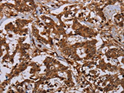The image on the left is immunohistochemistry of paraffin-embedded Human liver cancer tissue using the antibody Antibody) at dilution 1/30, on the right is treated with synthetic peptide. (Original magnification: ×200)