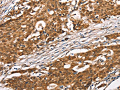 The image on the left is immunohistochemistry of paraffin-embedded Human gastric cancer tissue using DGAT1 Antibody(DGAT1 Antibody) at dilution 1/40, on the right is treated with synthetic peptide. (Original magnification: ×200)Rabbit anti-Human DGAT1 Polyclonal Antibody