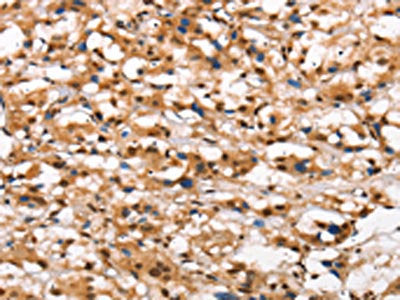 The image on the left is immunohistochemistry of paraffin-embedded Human thyroid cancer tissue using the antibody Antibody) at dilution 1/40, on the right is treated with synthetic peptide. (Original magnification: ×200)Rabbit anti-Human DGAT1 Polyclonal Antibody
