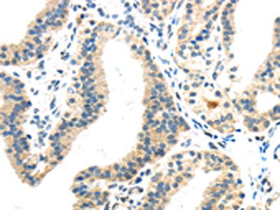The image on the left is immunohistochemistry of paraffin-embedded Human thyroid cancer tissue using INHBB Antibody(INHBB Antibody) at dilution 1/40, on the right is treated with synthetic peptide. (Original magnification: ×200)