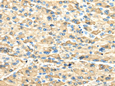 The image on the left is immunohistochemistry of paraffin-embedded Human liver cancer tissue using the antibody Antibody) at dilution 1/40, on the right is treated with synthetic peptide. (Original magnification: ×200)
